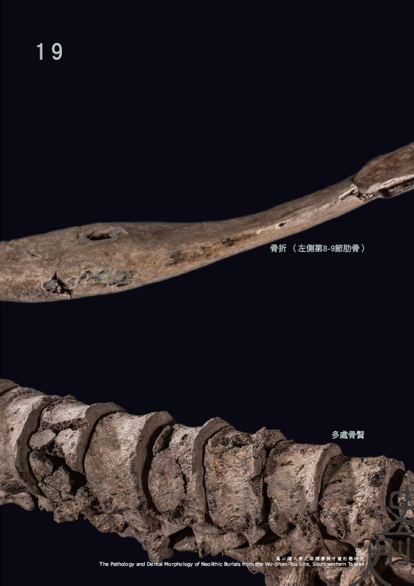 圖四 烏山頭遺址出土人骨之病理現象