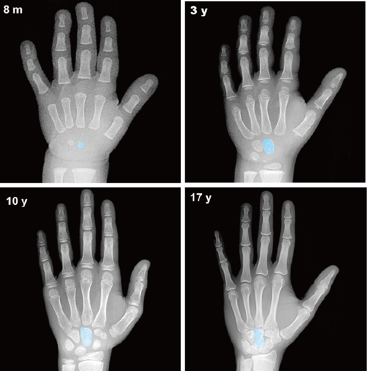 各年齡如8個月、3歲、10歲與17歲的手掌X光照，藍色為頭狀骨(capitate)（改自Gilsanz and Ratib 2005）。