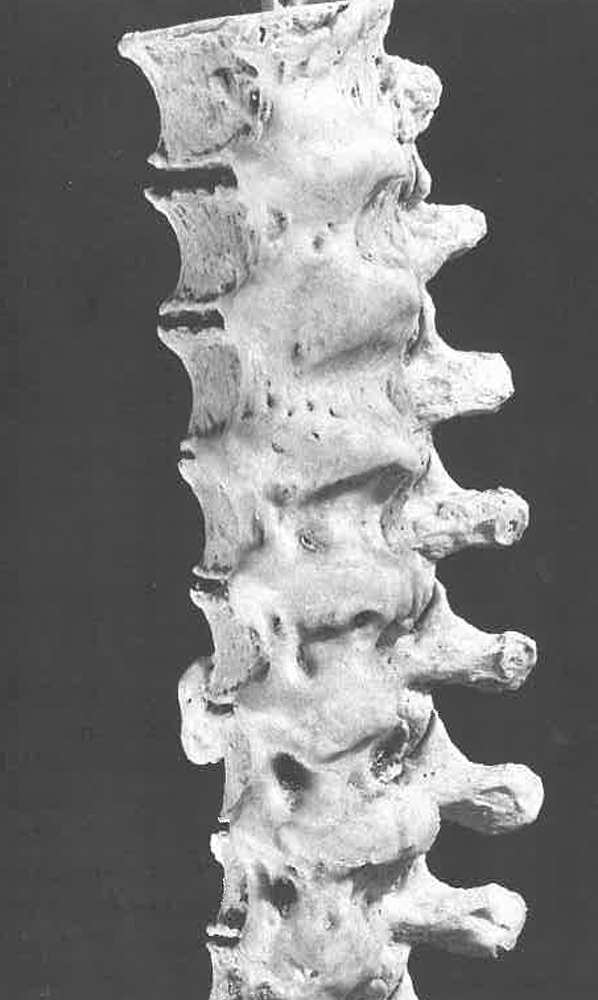 瀰漫性特發性骨肥厚(取自Aufderheide et al 1998)。