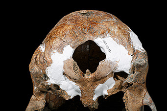 圖3、NKLE-D3B2枕骨大孔前緣節結。