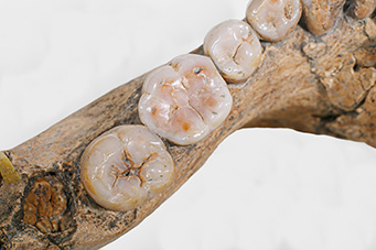 圖7、F3B4之Y型與+型牙槽